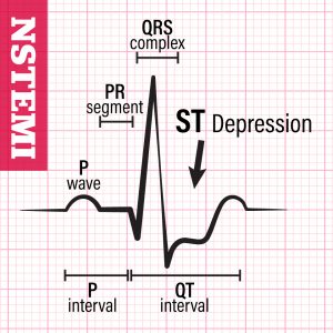 EKG waveforms associated with a less serious NSTEMI heart attack , in which coronary artery blockages are partial or temporary.