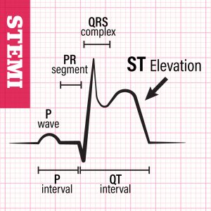 These EKG waveforms indicate a serious STEMI heart attack, in which a heart artery is totally blocked.