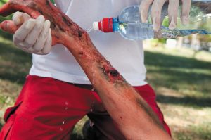 Burn treatment varies depending on type and severity, but cooling and flushing a burned area with water is usually a safe strategy.