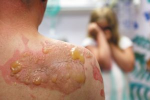 Second-degree burns involve deeper skin layers and produce blisters.