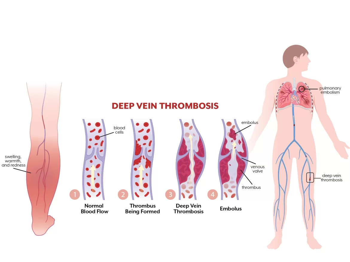 The Dangers Of DVT